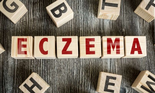 Екзема: причини, видове, симптоми и методи на лечение