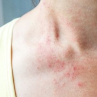 Какви са различните видове екзема?