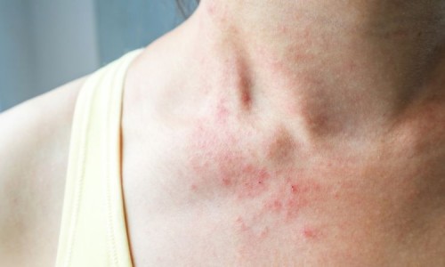 Какви са различните видове екзема?